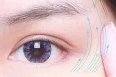 盐城开眼角会有哪些副作用