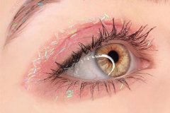 内眦赘皮矫正术要注意什么