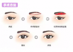 提眉手术让你告别苦瓜脸