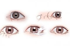 这些姑娘开了眼角，眼睛都漂亮了十几个档次了