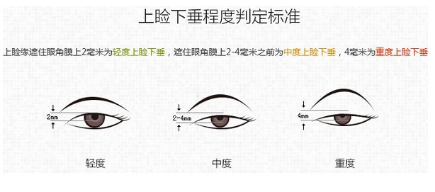 上睑下垂矫正,上睑下垂矫正价格