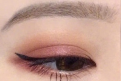 盐城上睑下垂的术后常见问题